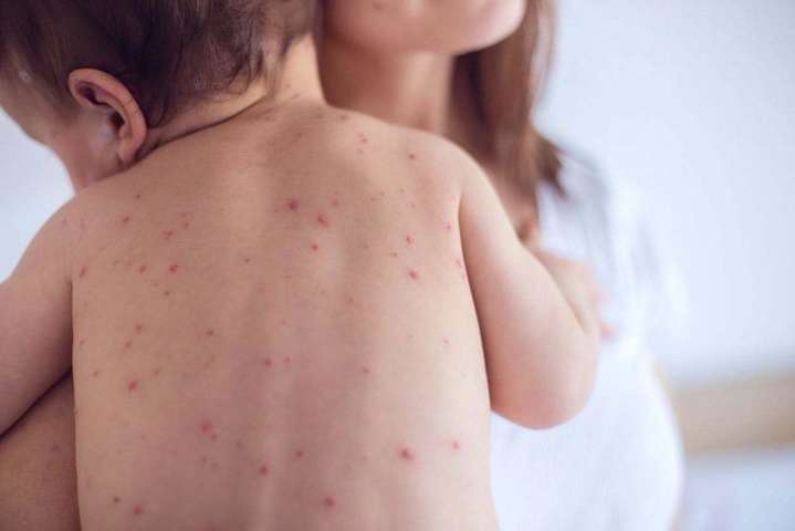 Скалецька повідомила про недостатню кількість вакцин від кору