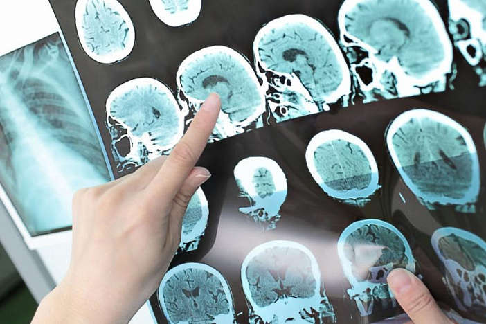 Медики попередили про ризик розвитку хвороби Альцгеймера після Covid-19