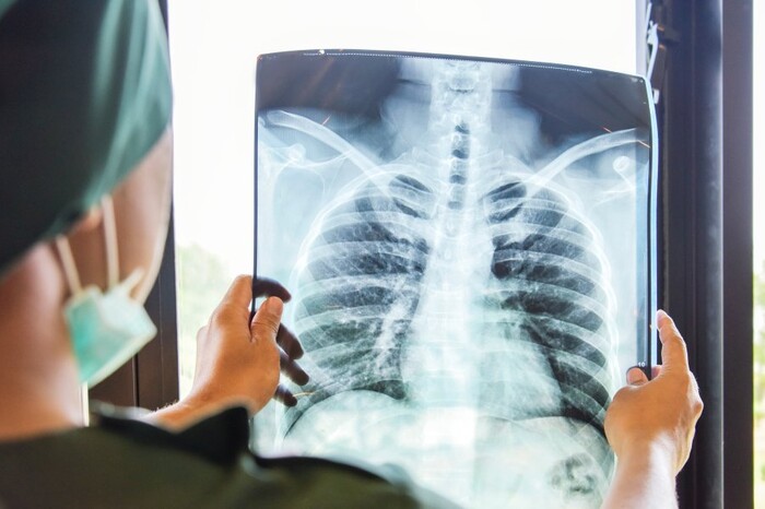 В Україні може зрости кількість хворих на туберкульоз: МОЗ назвав причину
