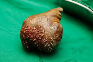  Хірурги видалили найбільший у світі камінь у нирках